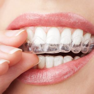 Invisalign